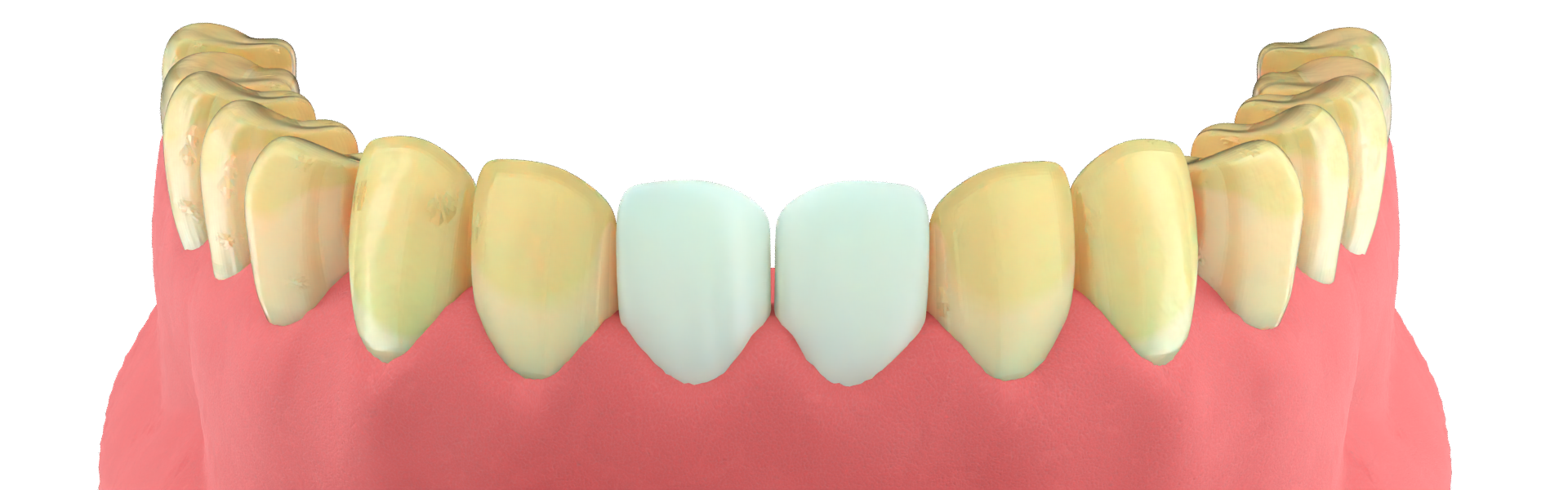 Alt Veneer