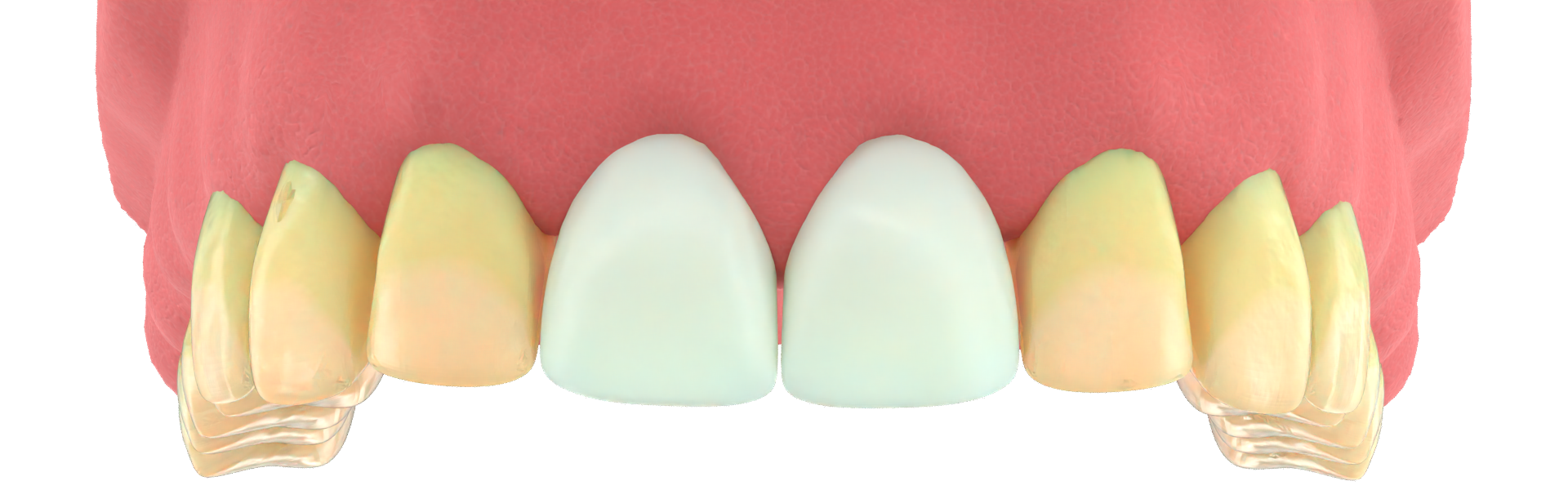 Üst Veneer